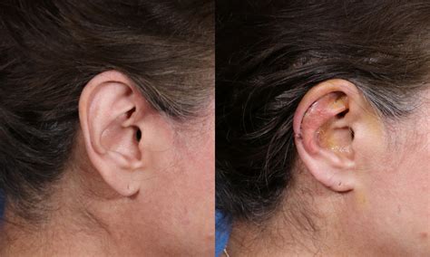 Earlobe Reduction For Large Prominent Ears World Expert In Making