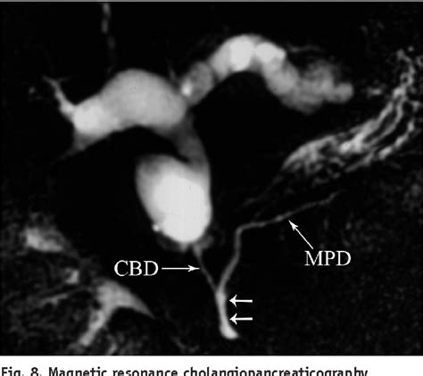 Figure 5 From Congenital Variants And Anomalies Of The Pancreas And
