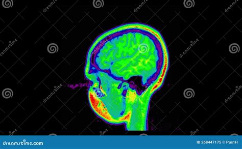 Human Mri Brain Scan On Black Background Computed Tomography Of The
