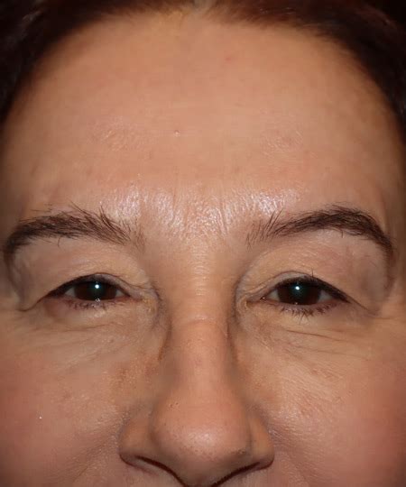 Before And After Gallery Laser Assisted Oculofacial Surgery