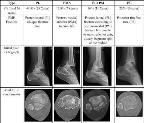 Figure From The Highly Variable Typologies Of Posterior Malleolus Fractures Of The Ankle
