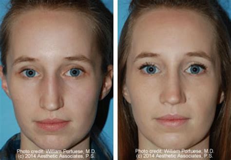 Low Bridge Glabella Before And After Photo Gallery