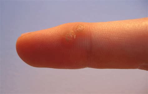 5 Important Facts About Warts You Need To Know Laser Lipo And Veins