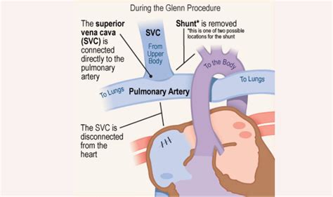 Understanding The Glenn Procedure A Comprehensive Guide For Indian