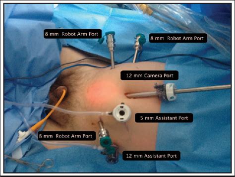 Figure From Robot Assisted Radical Prostatectomy How I Do It Part I Patient Preparation And