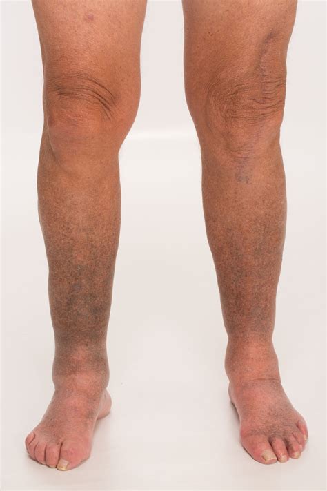 A 77 Year Old With Cutaneous Hyperpigmentation And Lower Extremity