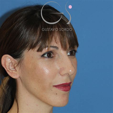 Rinoplastia Ultrasónica En Mujer De 32 Años Gustavo Sordo Cirujano