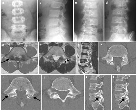 Typical Isthmic Spondyolysis 12 Year Old Male With Back Pain Plain