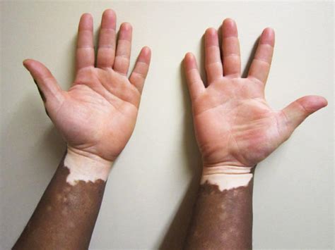 Vitiligo Illustrated Guide To Pigmentation Disorder