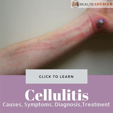 Cellulitis Causes Picture Symptoms Diagnosis And Treatment