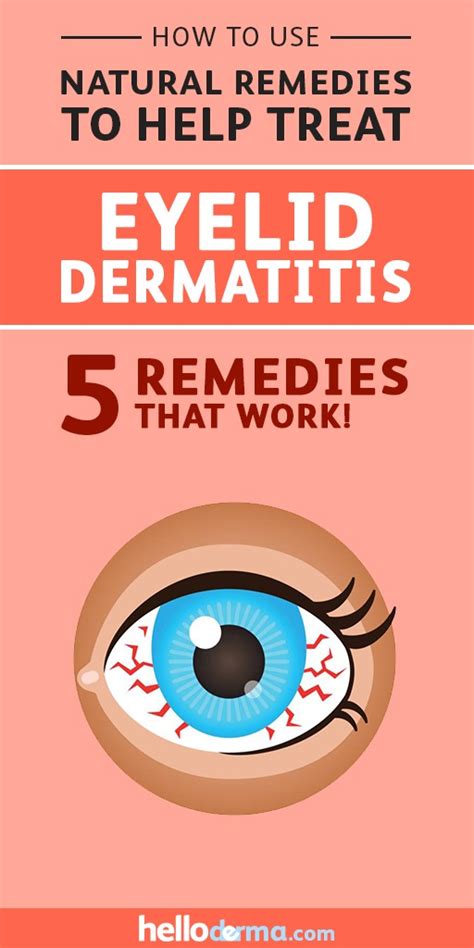5 Natural Remedies To Treat Eyelid Dermatitis