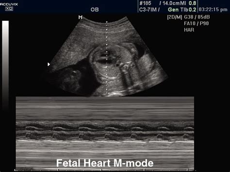 Ultrasound Images Fetal Heart M Mode Echogramm №299