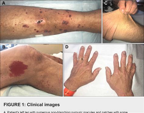 Figure 1 From Leukocytoclastic Vasculitis In A Patient With Classic