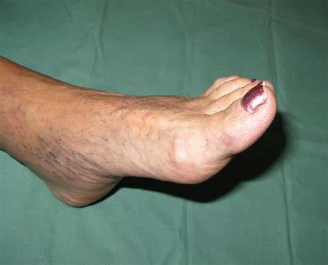 The Purple Toe Syndrome In Female With Factor V Leiden Mutation