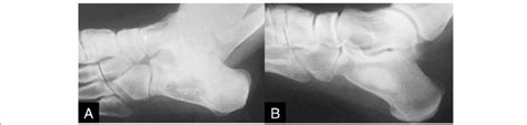 A A 27 Year Old Patient With Lipoma Of The Calcaneus Who Received