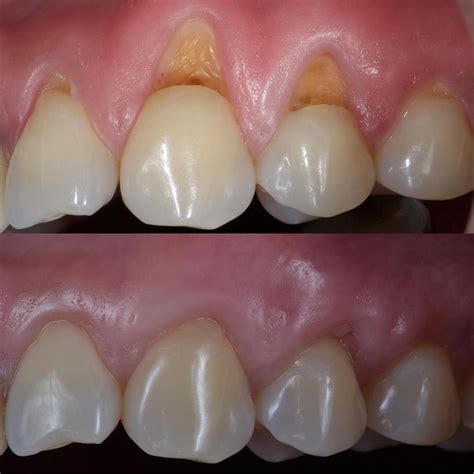Treatment For Abfraction Tooth Wear Dental Fillings Dental Treatment Dental