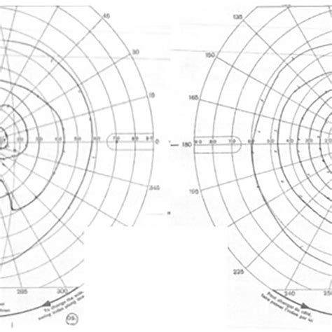 Vision Test Formal Goldmann Visual Field Testing Revealed A Bitemporal