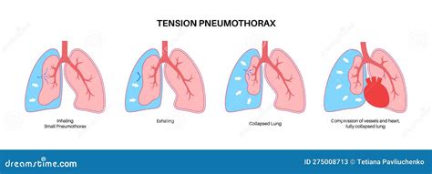 Tension Pneumothorax Poster Stock Vector Illustration Of Pneumothorax