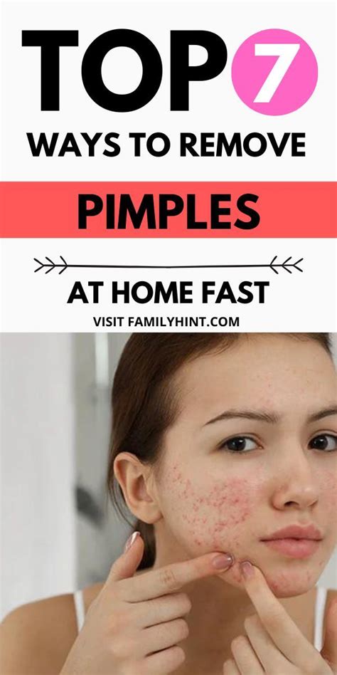 How To Get Rid Of Pimples Overnight 10 Home Remedies For Pimples Artofit