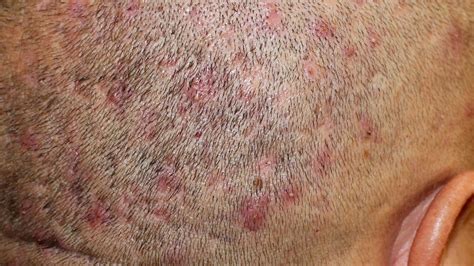 Folliculitis Shampoo Head Itching Antipruritic Cream Pimple Redness