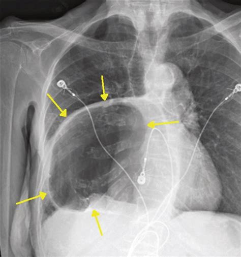Chest Xray Showing Intrathoracic Hiatal Hernia Compressing The Heart