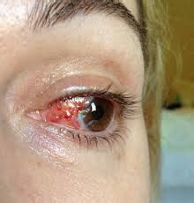 The most common type of eye cancer in children is retinoblastoma. Eye melanoma | Brazil| PDF | PPT| Case Reports | Symptoms ...