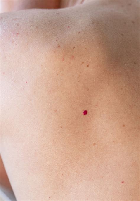 Cherry Angiomas Laser And Skin Clinics