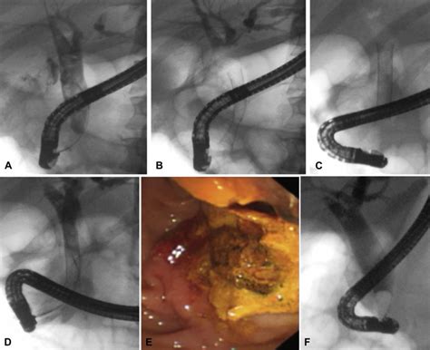 Covered Self Expanding Metal Stents For The Management Of Common Bile
