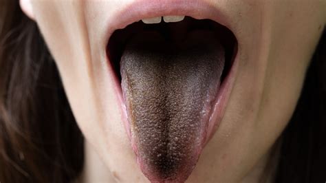 This Is What Really Causes A Hairy Tongue