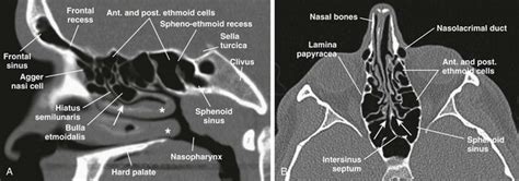Nasal Bone Anatomy Ct Axial