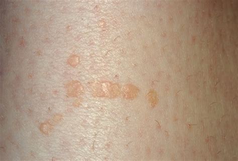 Hpv Flat Warts Pictures Photos