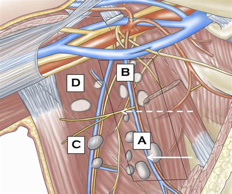 Upper Outer Boundaries Of The Axillary Dissection Result Of The