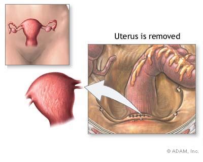 Medical Images Hysterectomy Hysterectomy Recovery Post Hysterectomy