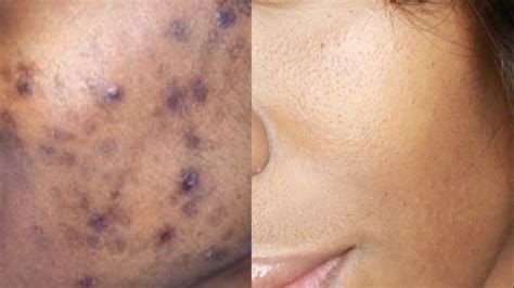 Video How To Get Rid Of Dark Spots Acne Scars And Hyperpigmentation