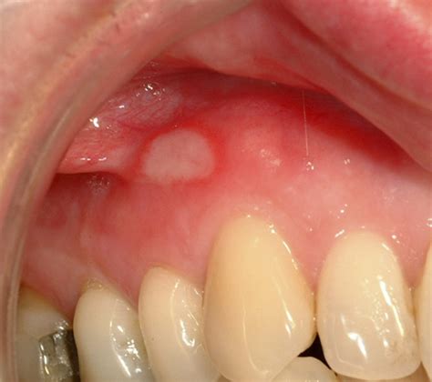 References In Oral Mucosal Disease Recurrent Aphthous Stomatitis