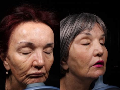 Forehead Temple Facial Rejuvenation Fl
