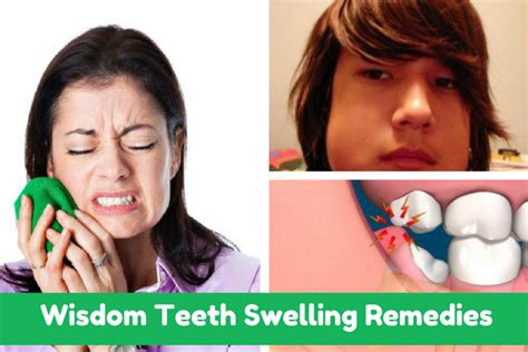 What Can Help With Wisdom Teeth Swelling Teethwalls