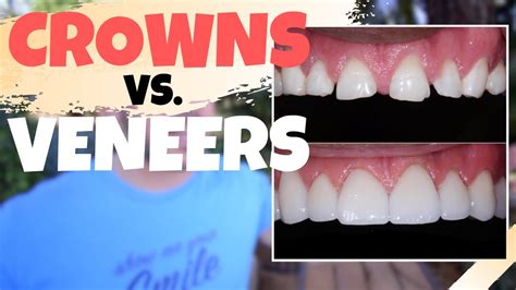 Dental Crowns Vs Porcelain Veneers Is The Dental Veneers Procedure