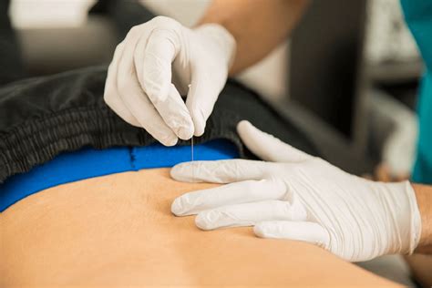 Dry Needling For Back Pain Sports Focus Physiotherapy Blog