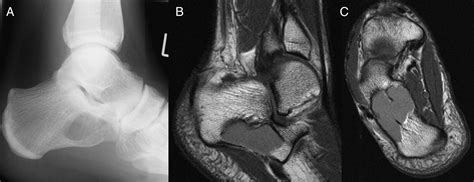 Unicameral Bone Cyst In The Calcaneus Of Mirror Image Twins The