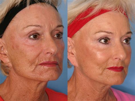 Sculptra Before And After Pictures Case 64 Naples And Ft Myers Fl