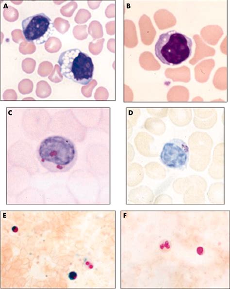 Blood Film Examination For Vacuolated Lymphocytes In The Diagnosis Of