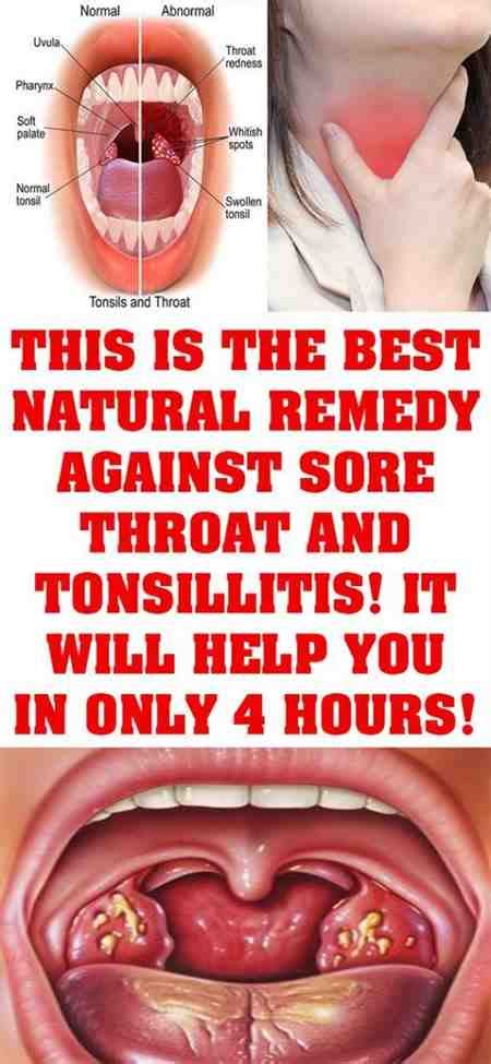 Persistent Sore Throat And Burping Remedy Tonsils V Alert Vrtl T Tonsil