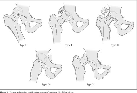 Hip Dislocation And Head Of Femur Fracture Yong Yao Tan