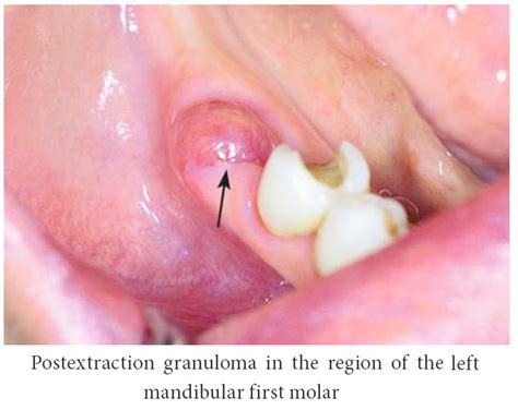 Tooth Removal Warnings Exodontia
