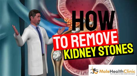 How To Remove Kidney Stones Male Health Clinic