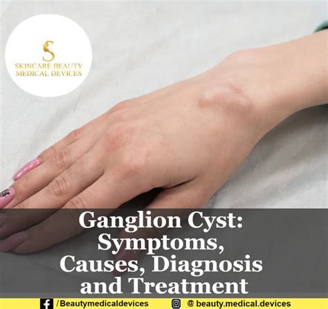 Ganglion Cyst Symptoms Causes Diagnosis And Treatment