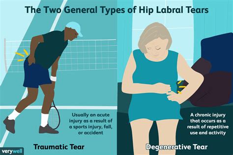 Labral Tear Of The Hip Joint Causes And Treatments