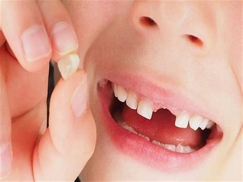 تفسير حلم سقوط الاسنان الامامية للعزباء