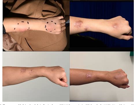 Figure 1 From Mycobacterium Abscessus Skin And Soft Tissue Infection